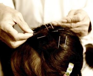 Acupuncture clinic in chennai